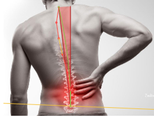 Diagram illustrating vertebral compensation mechanisms — OPS Clinic software